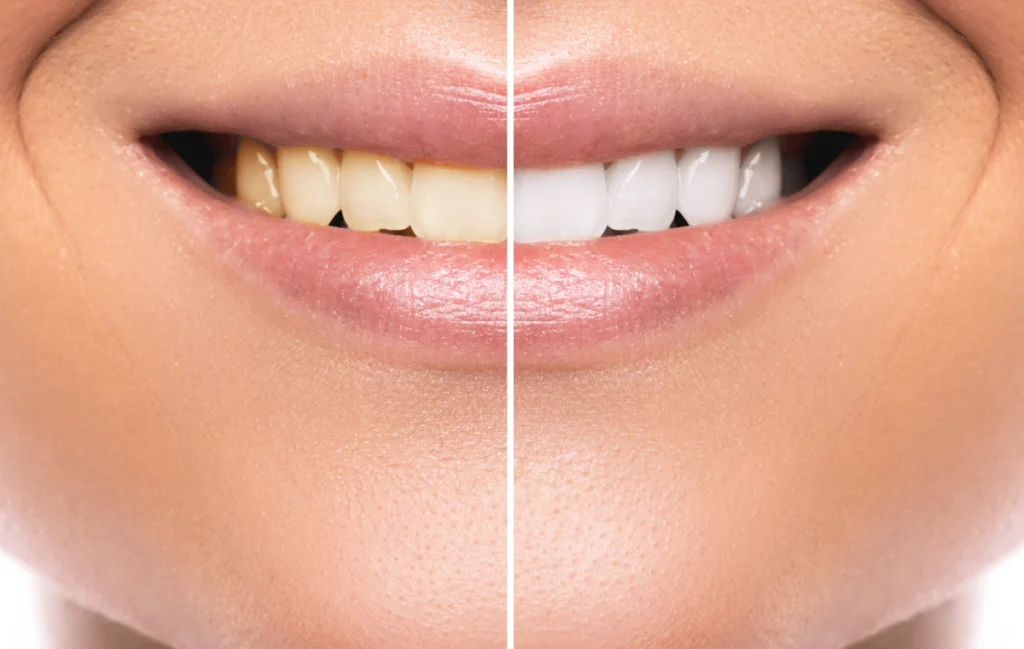 blanchiment-dentaire-pernes-les-fontaines blanchiment-dentaire-pernes-les-fontaines Blanchiment dentaire : comment conserver les résultats du traitement ? Dentistes à Pernes-les-Fontaines | Pôle 158