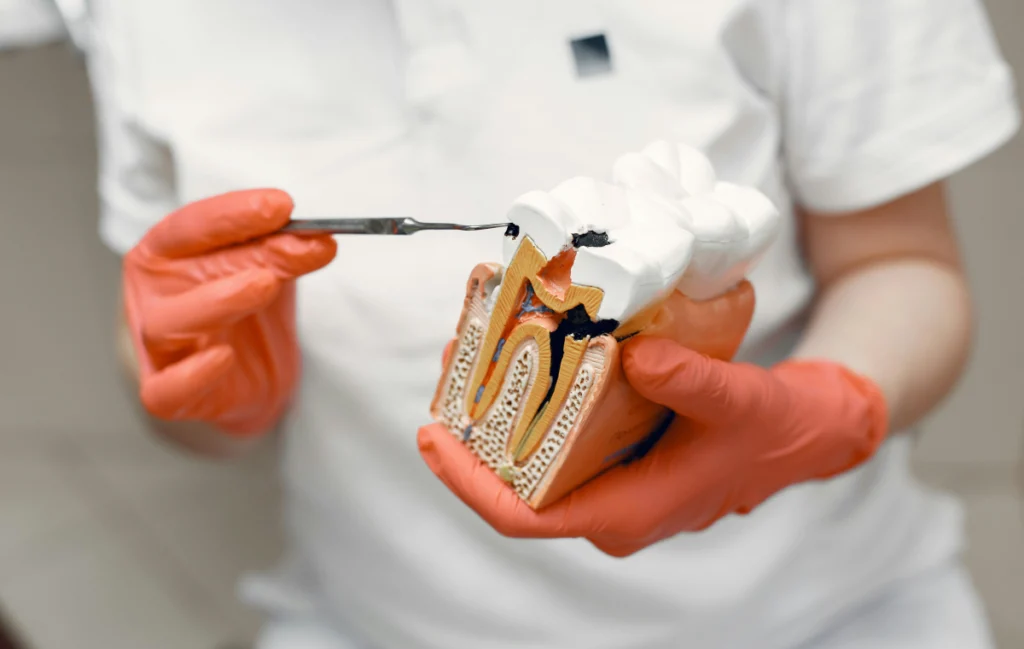 caries-dentiste-pernes-les-fontaines caries-dentiste-pernes-les-fontaines Inlay Dentistes à Pernes-les-Fontaines | Pôle 158