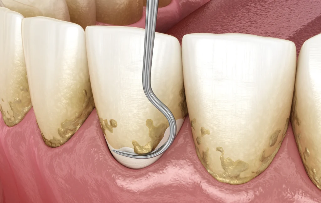 detartrage-dentistes-pernes-les-fontaines detartrage-dentistes-pernes-les-fontaines Conseils pré-opératoires Dentistes à Pernes-les-Fontaines | Pôle 158