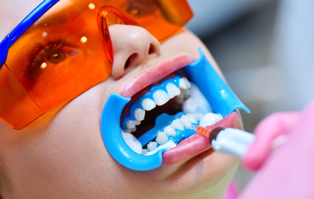 eclaircissement-dentiste-pernes-les-fontaines eclaircissement-dentiste-pernes-les-fontaines Blanchiment dentaire : comment conserver les résultats du traitement ? Dentistes à Pernes-les-Fontaines | Pôle 158