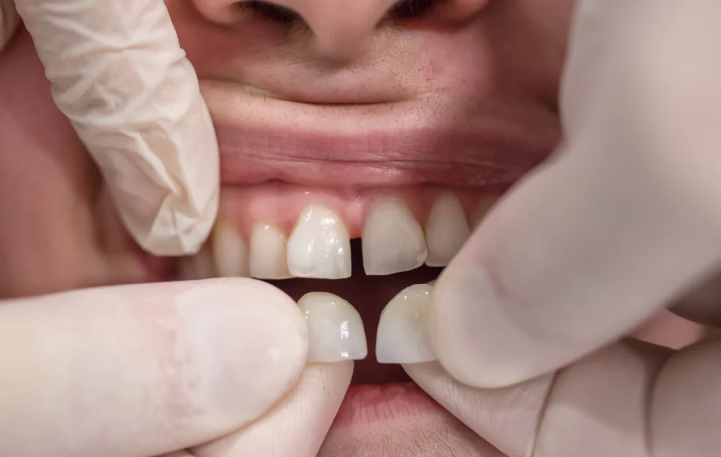 facettes-ceramiques-dentiste-pernes-les-fontaines facettes-ceramiques-dentiste-pernes-les-fontaines Facettes Dentistes à Pernes-les-Fontaines | Pôle 158