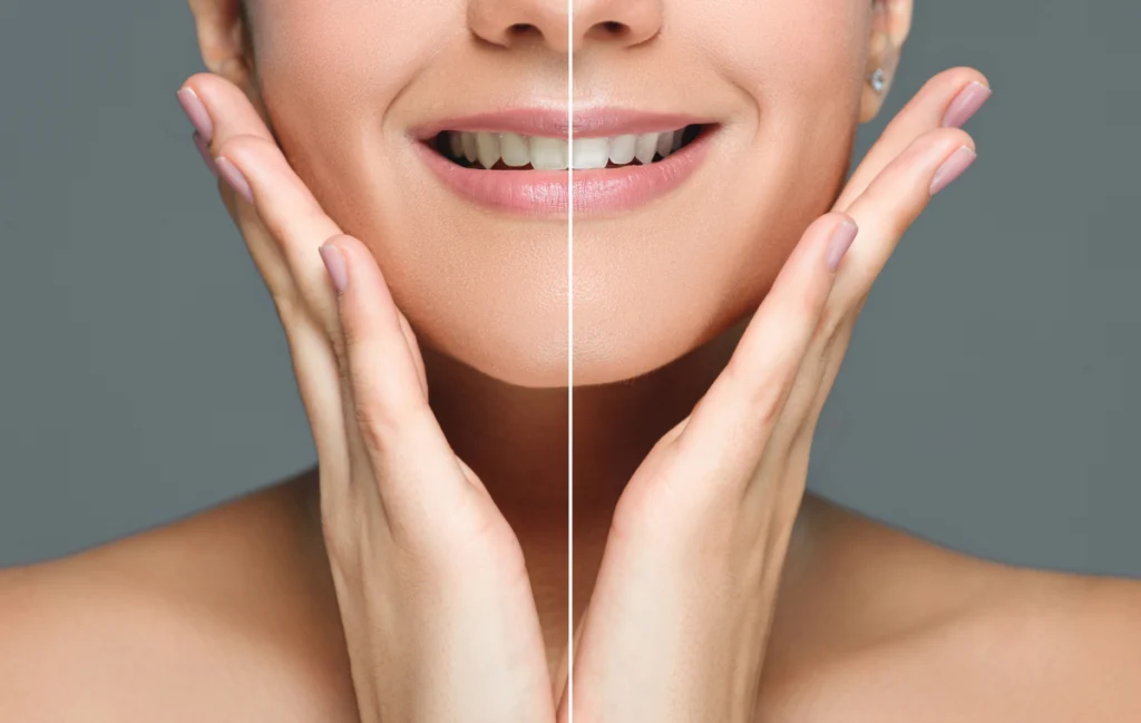 blanchiment-dentistaire-pernes-les-fontaines blanchiment-dentistaire-pernes-les-fontaines Blanchiment dentaire Dentistes à Pernes-les-Fontaines | Pôle 158